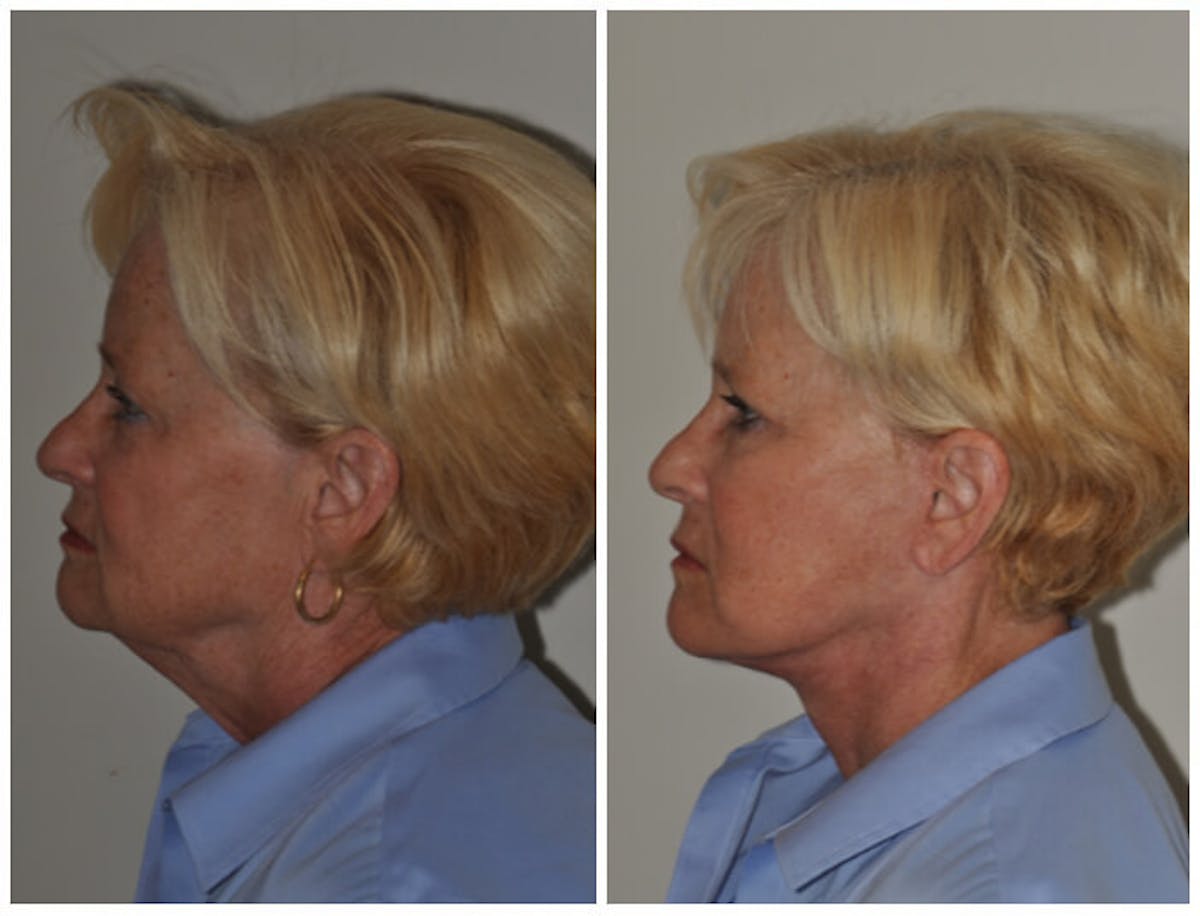 Facelift Before & After Gallery - Patient 192046 - Image 1