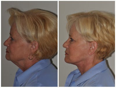 Facelift Before & After Gallery - Patient 192046 - Image 1