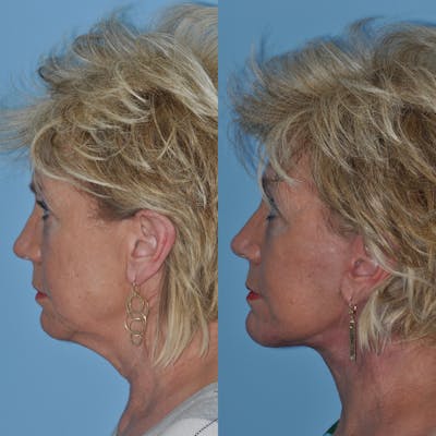 Facelift Before & After Gallery - Patient 849929 - Image 1