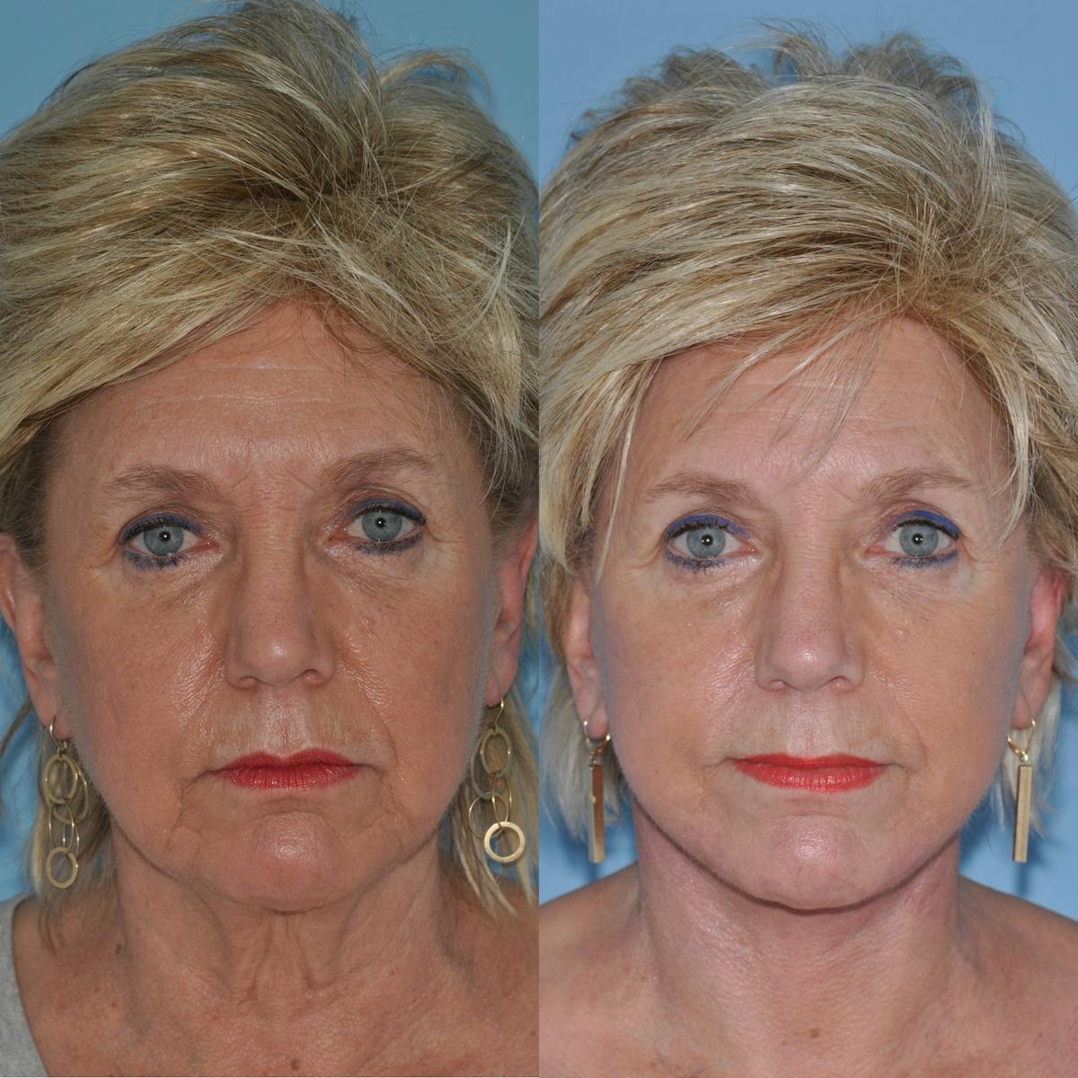 Facelift Before & After Gallery - Patient 849929 - Image 2