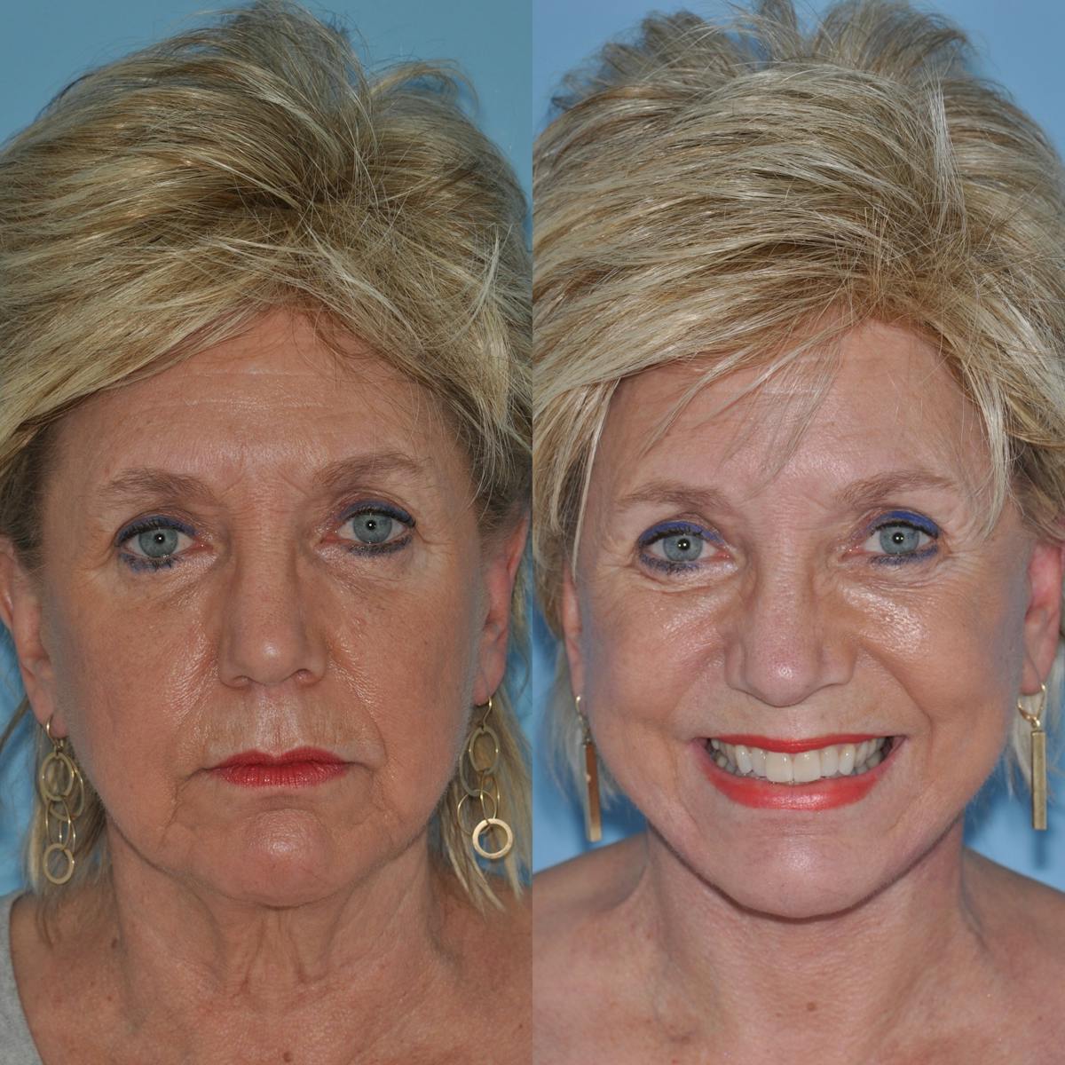 Facelift Before & After Gallery - Patient 849929 - Image 4