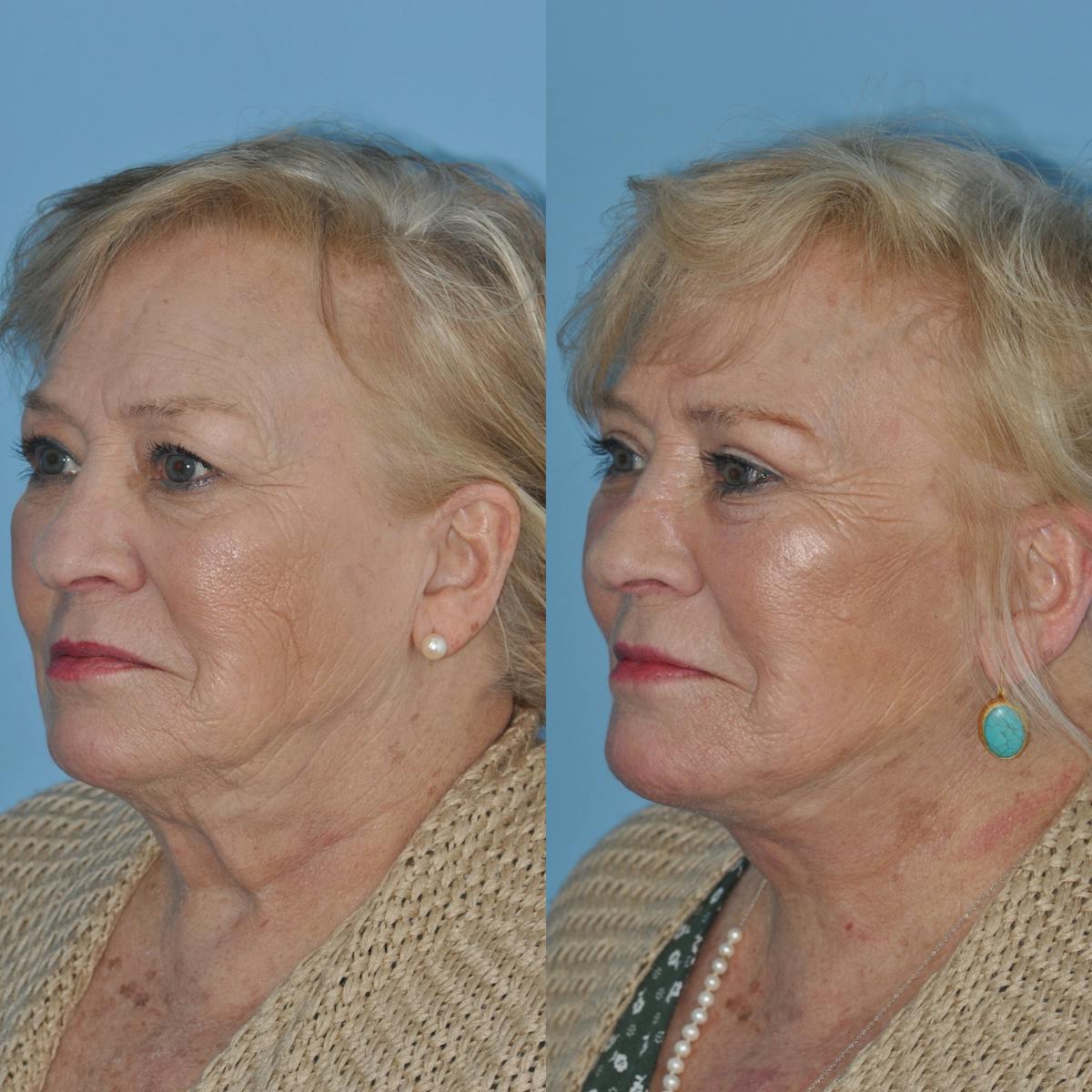 Facelift Before & After Gallery - Patient 382098 - Image 1