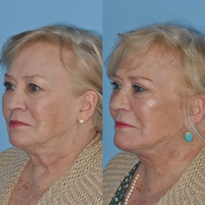Facelift Before & After Gallery - Patient 382098 - Image 1