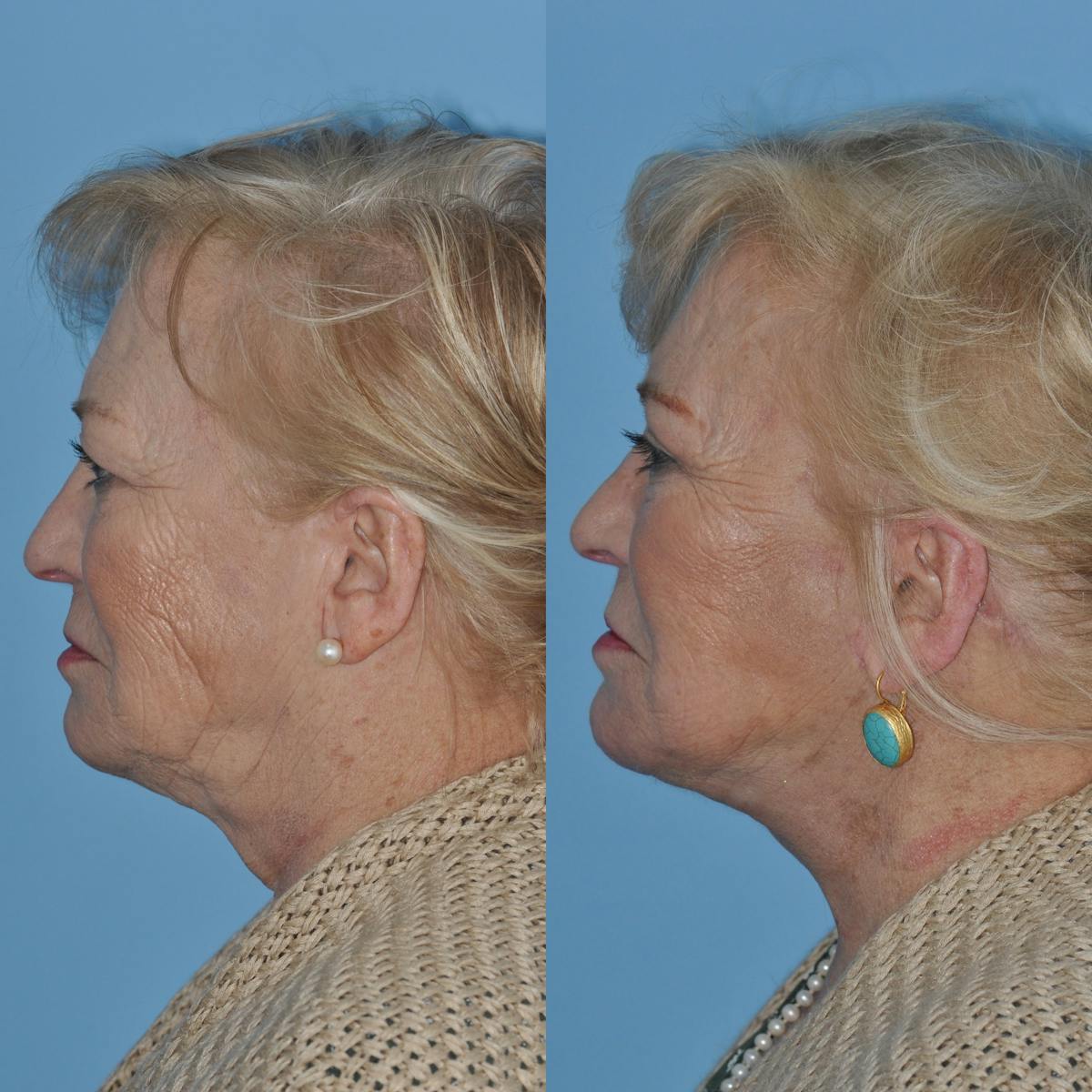 Facelift Before & After Gallery - Patient 382098 - Image 2