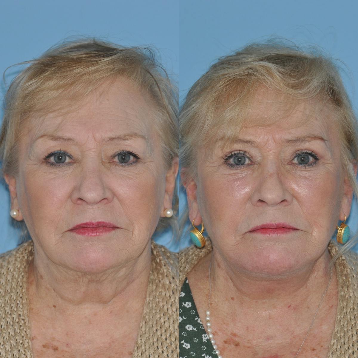 Facelift Before & After Gallery - Patient 382098 - Image 3