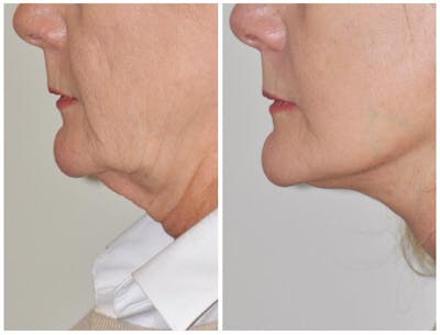 Facelift Before & After Gallery - Patient 286095 - Image 1