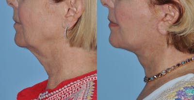 Facelift Before & After Gallery - Patient 358419 - Image 1