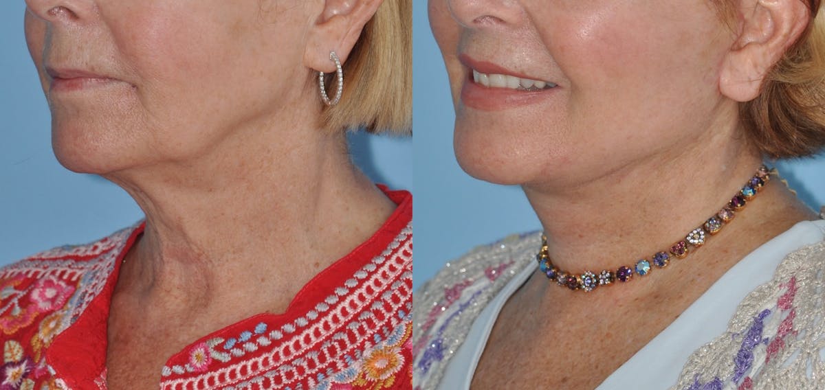 Facelift Before & After Gallery - Patient 358419 - Image 2