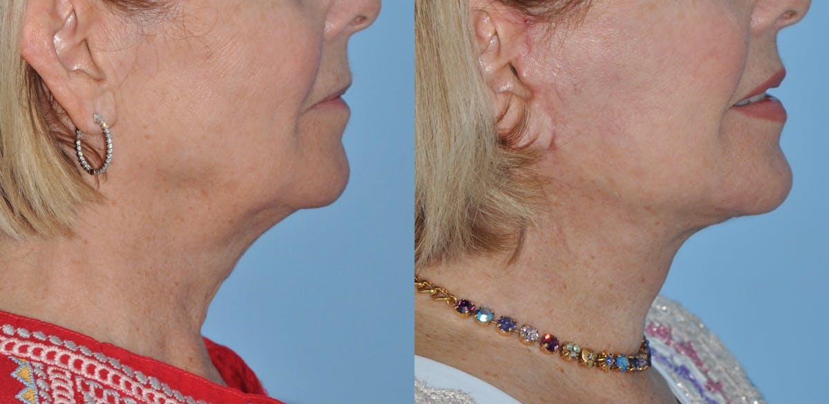Facelift Before & After Gallery - Patient 358419 - Image 3