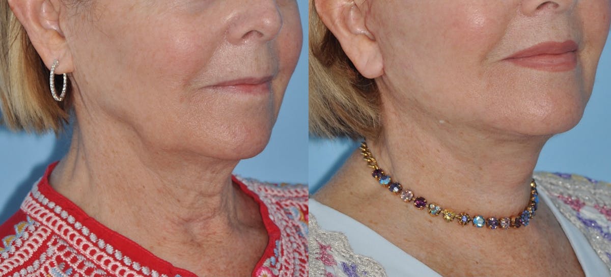 Facelift Before & After Gallery - Patient 358419 - Image 4