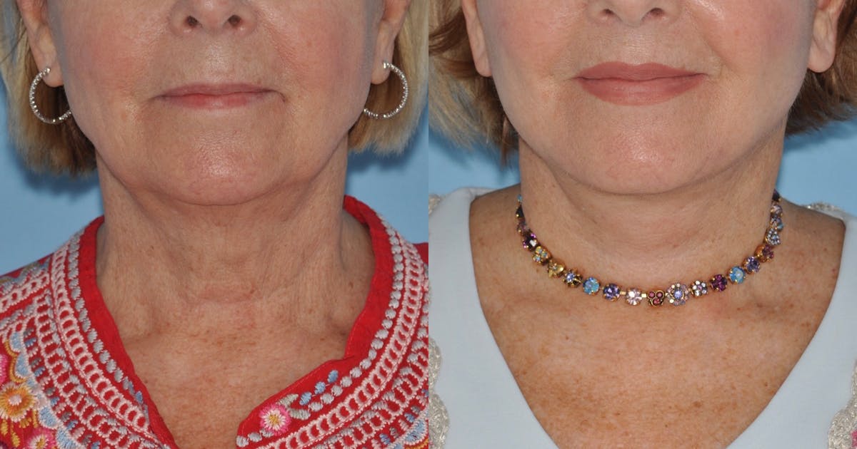 Facelift Before & After Gallery - Patient 358419 - Image 5