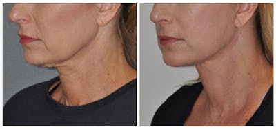 Facelift Before & After Gallery - Patient 422467 - Image 1