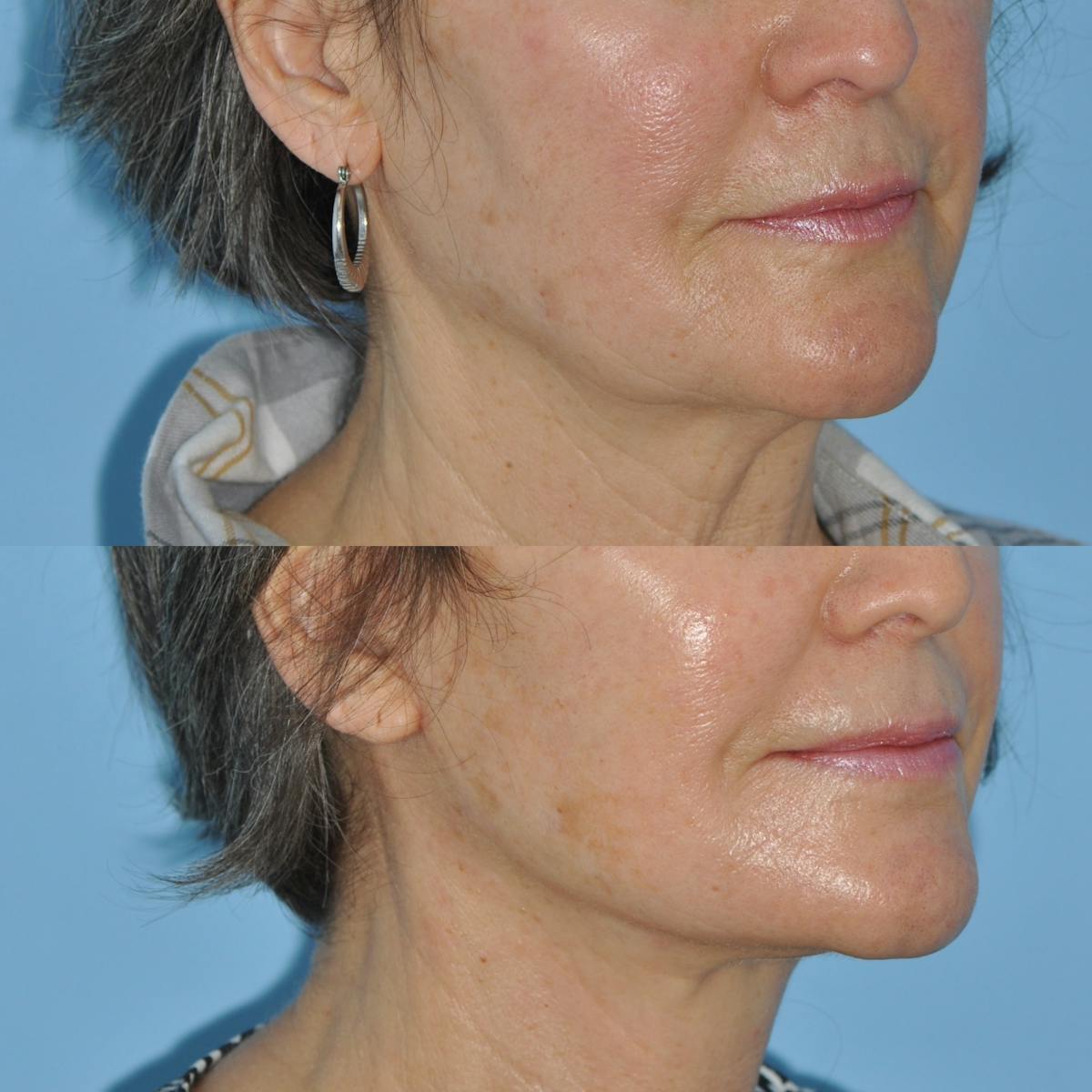 Facelift Before & After Gallery - Patient 830459 - Image 1