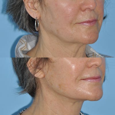 Facelift Before & After Gallery - Patient 830459 - Image 1