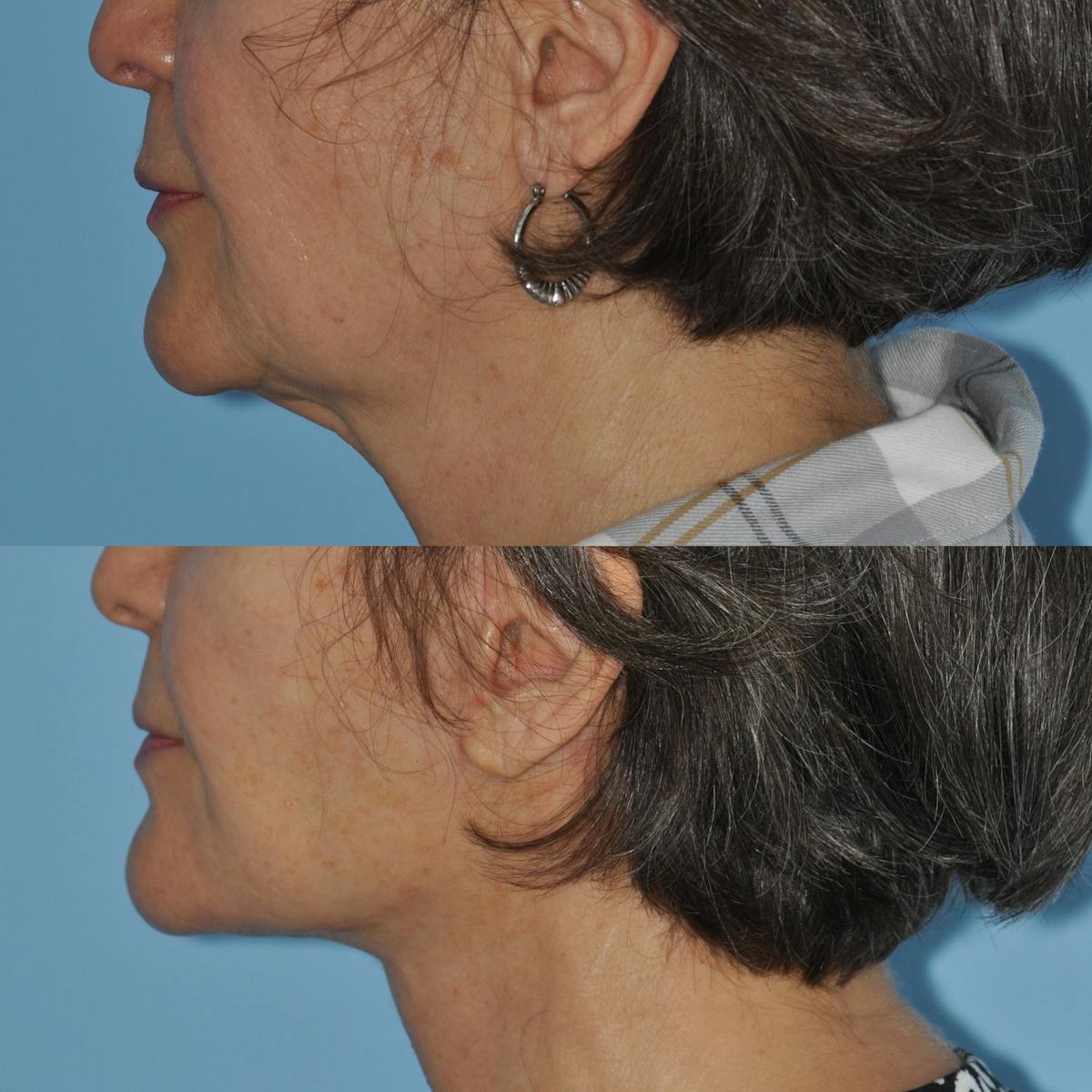 Facelift Before & After Gallery - Patient 830459 - Image 2