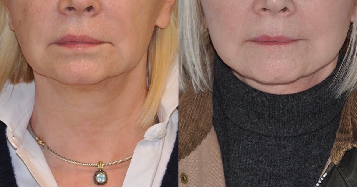 Facelift Before & After Gallery - Patient 135576 - Image 1