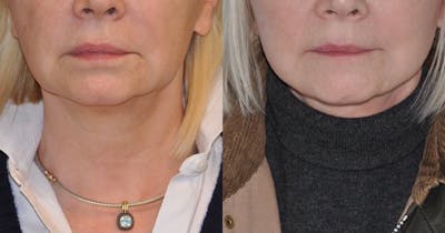 Facelift Before & After Gallery - Patient 135576 - Image 1