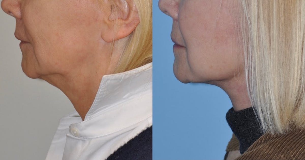 Facelift Before & After Gallery - Patient 135576 - Image 2