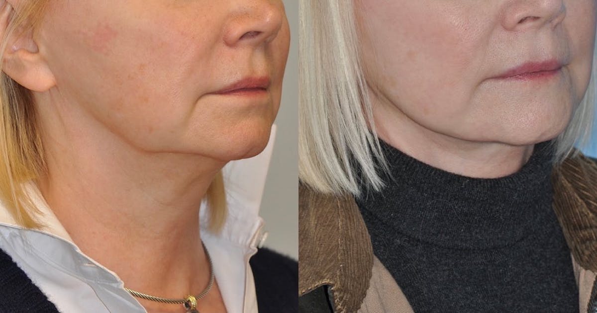 Facelift Before & After Gallery - Patient 135576 - Image 3