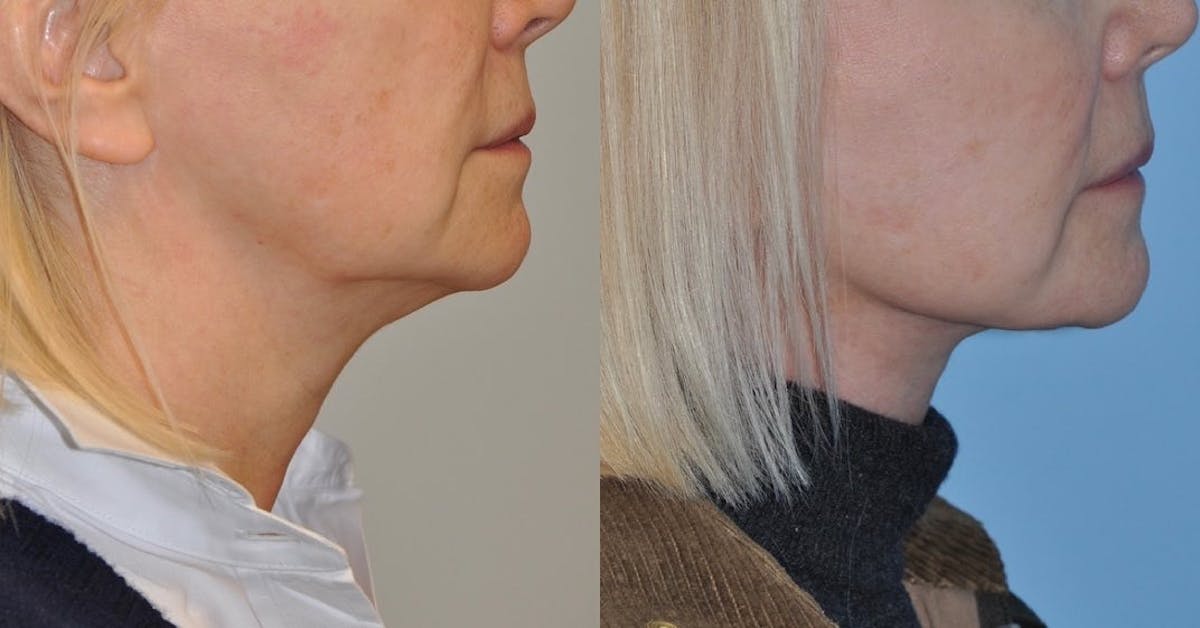 Facelift Before & After Gallery - Patient 135576 - Image 4