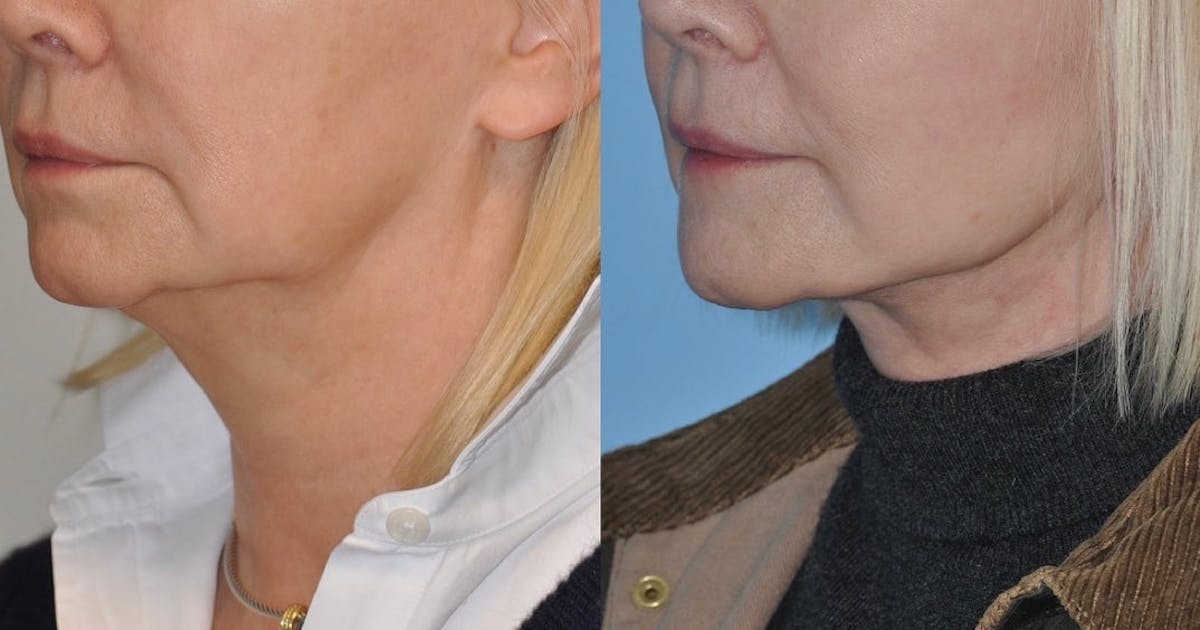 Facelift Before & After Gallery - Patient 135576 - Image 5