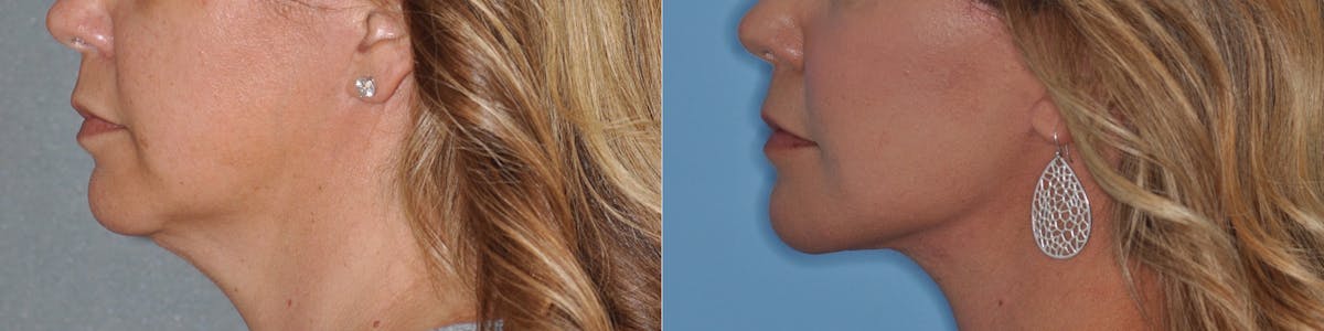 Facelift Before & After Gallery - Patient 967024 - Image 5