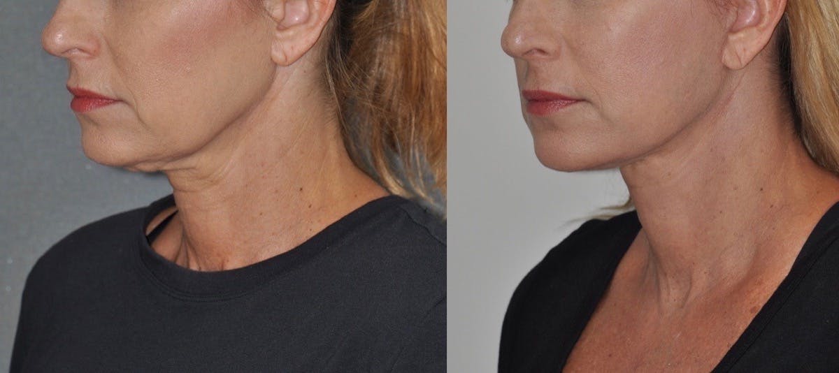 Facelift Before & After Gallery - Patient 192734 - Image 2