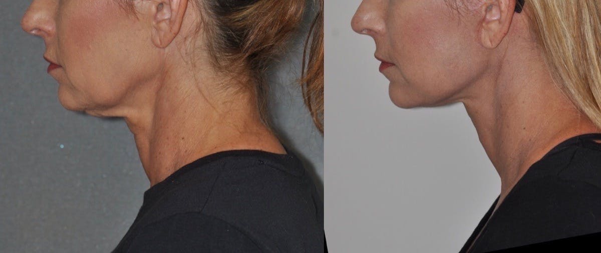 Facelift Before & After Gallery - Patient 192734 - Image 3