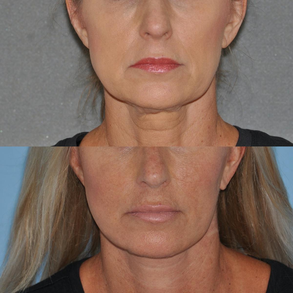 Facelift Before & After Gallery - Patient 312782 - Image 1