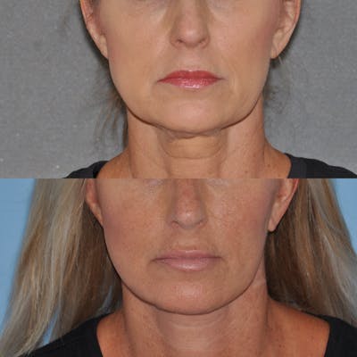 Facelift Before & After Gallery - Patient 312782 - Image 1