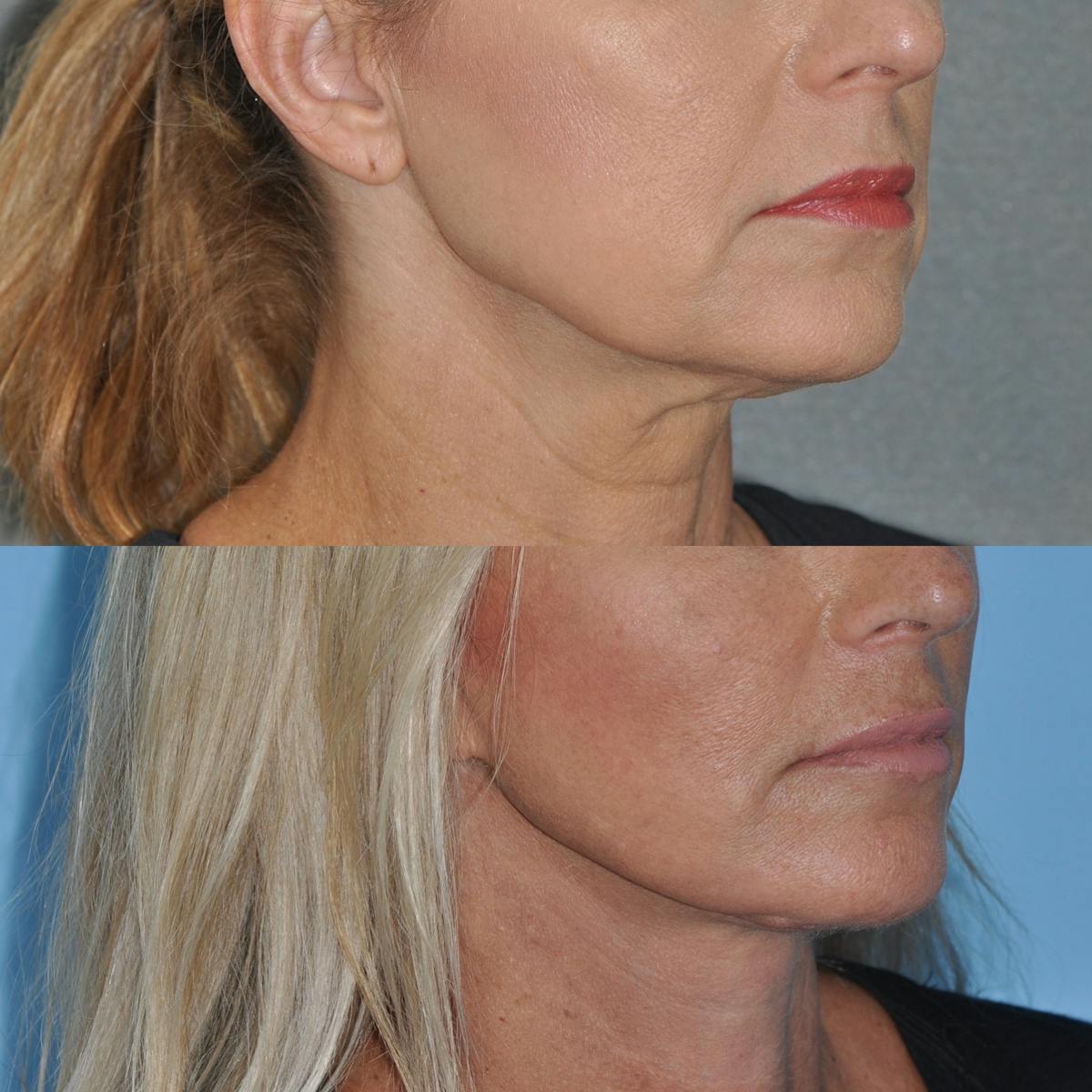 Facelift Before & After Gallery - Patient 312782 - Image 2