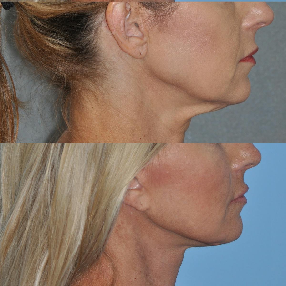 Facelift Before & After Gallery - Patient 312782 - Image 3