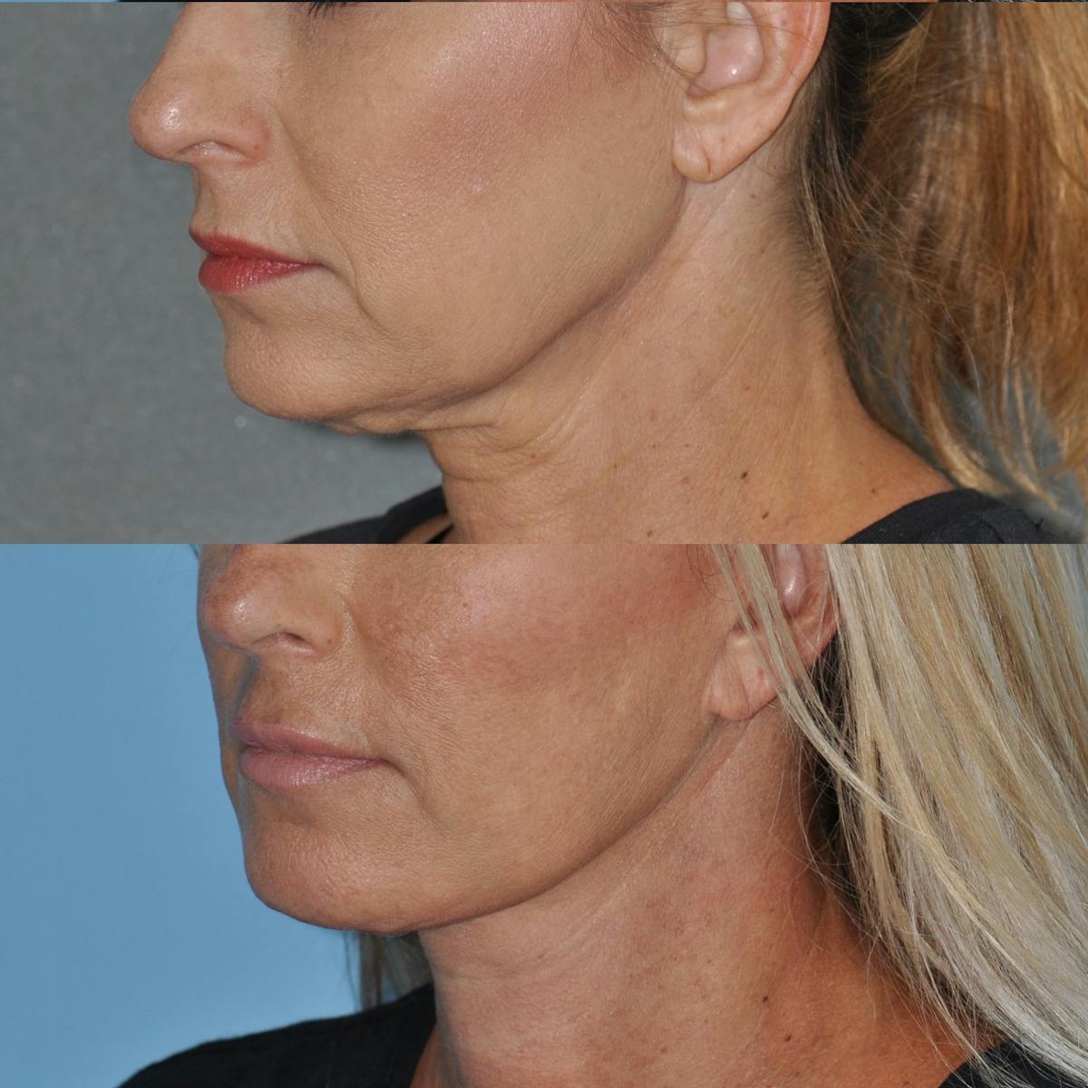Facelift Before & After Gallery - Patient 312782 - Image 4