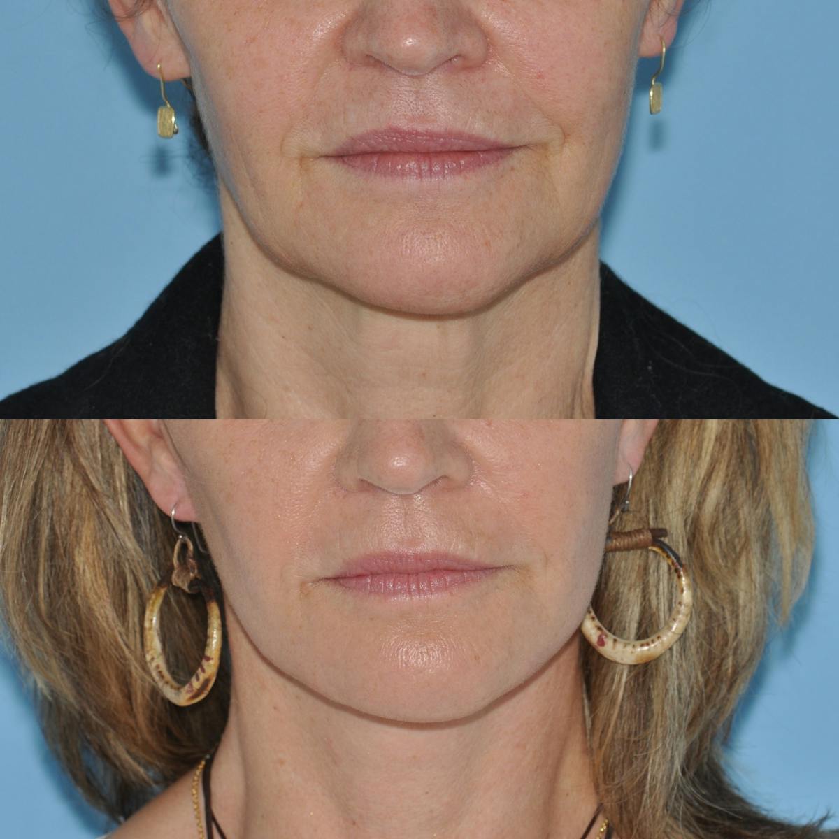 Facelift Before & After Gallery - Patient 100447 - Image 1