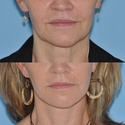Facelift Before & After Gallery - Patient 100447 - Image 1