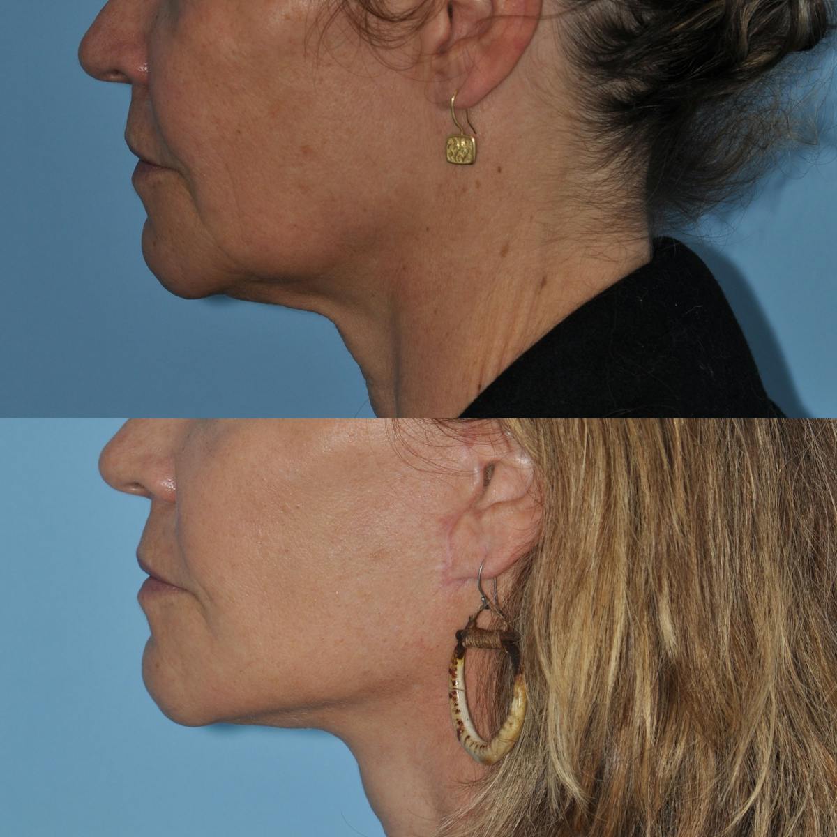 Facelift Before & After Gallery - Patient 100447 - Image 2