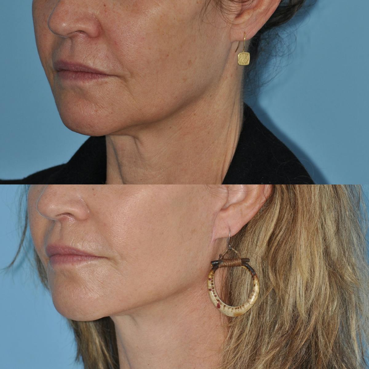 Facelift Before & After Gallery - Patient 100447 - Image 3