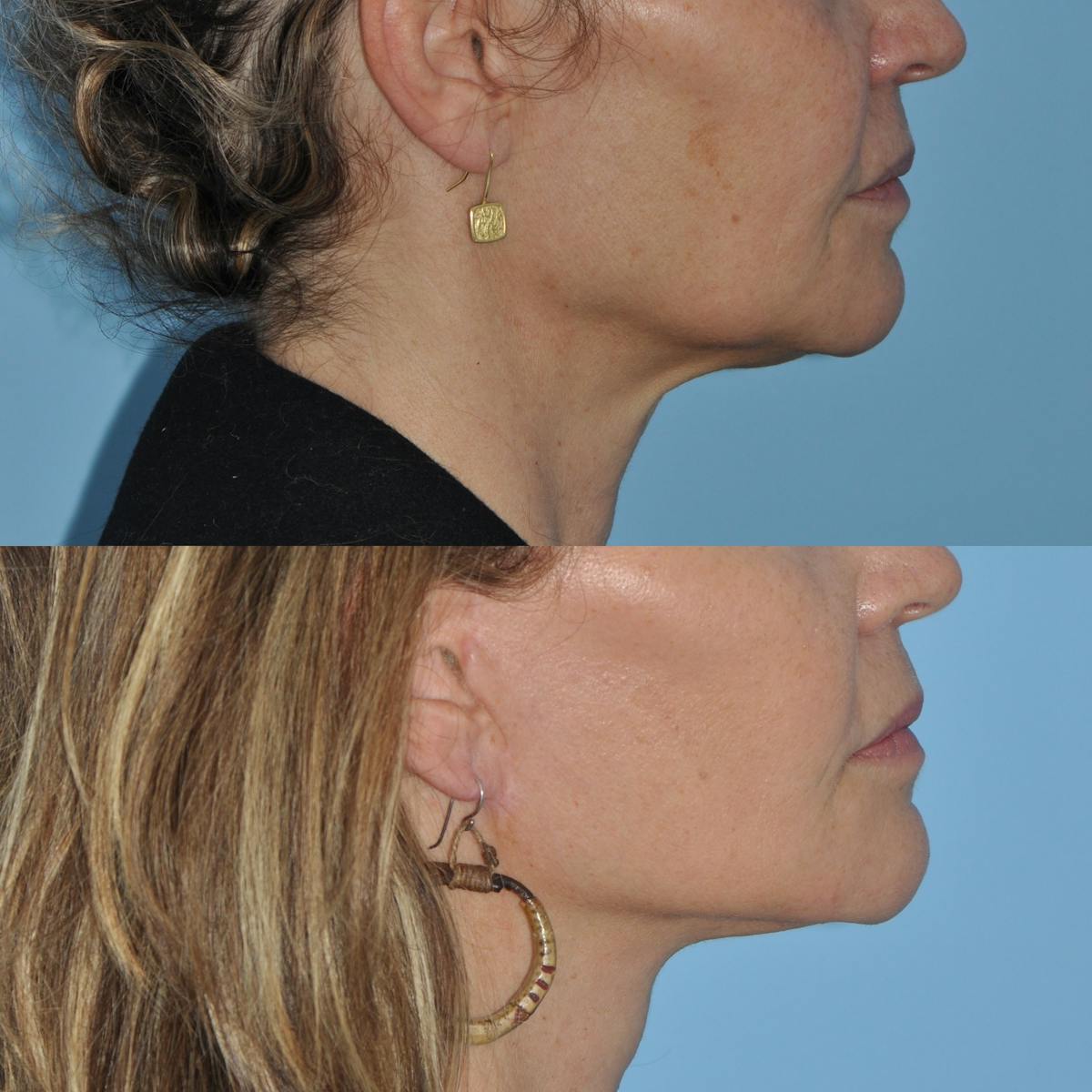 Facelift Before & After Gallery - Patient 100447 - Image 4