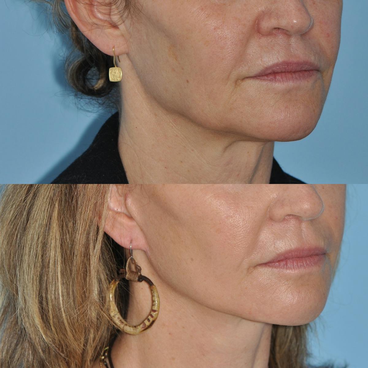 Facelift Before & After Gallery - Patient 100447 - Image 5