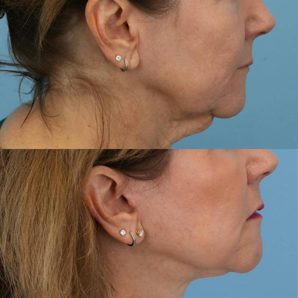Facelift Before & After Gallery - Patient 399981 - Image 4