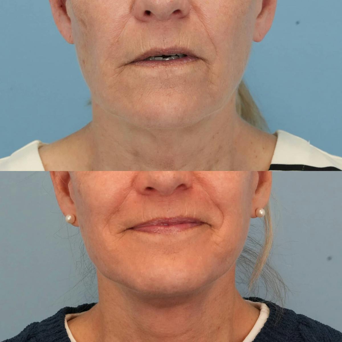 Facelift Before & After Gallery - Patient 577373 - Image 1