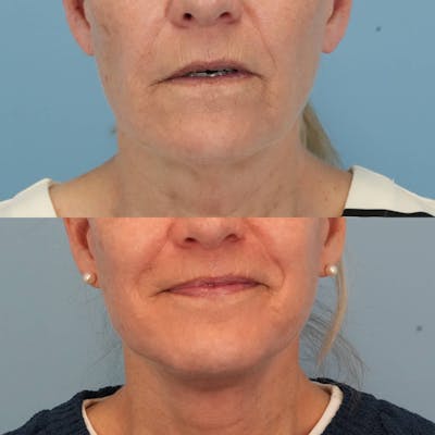 Facelift Before & After Gallery - Patient 577373 - Image 1