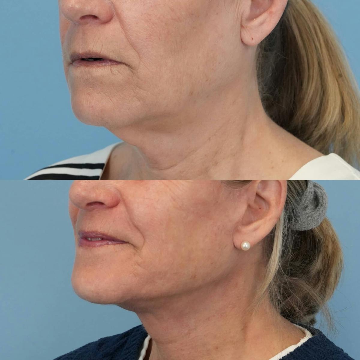 Facelift Before & After Gallery - Patient 577373 - Image 2