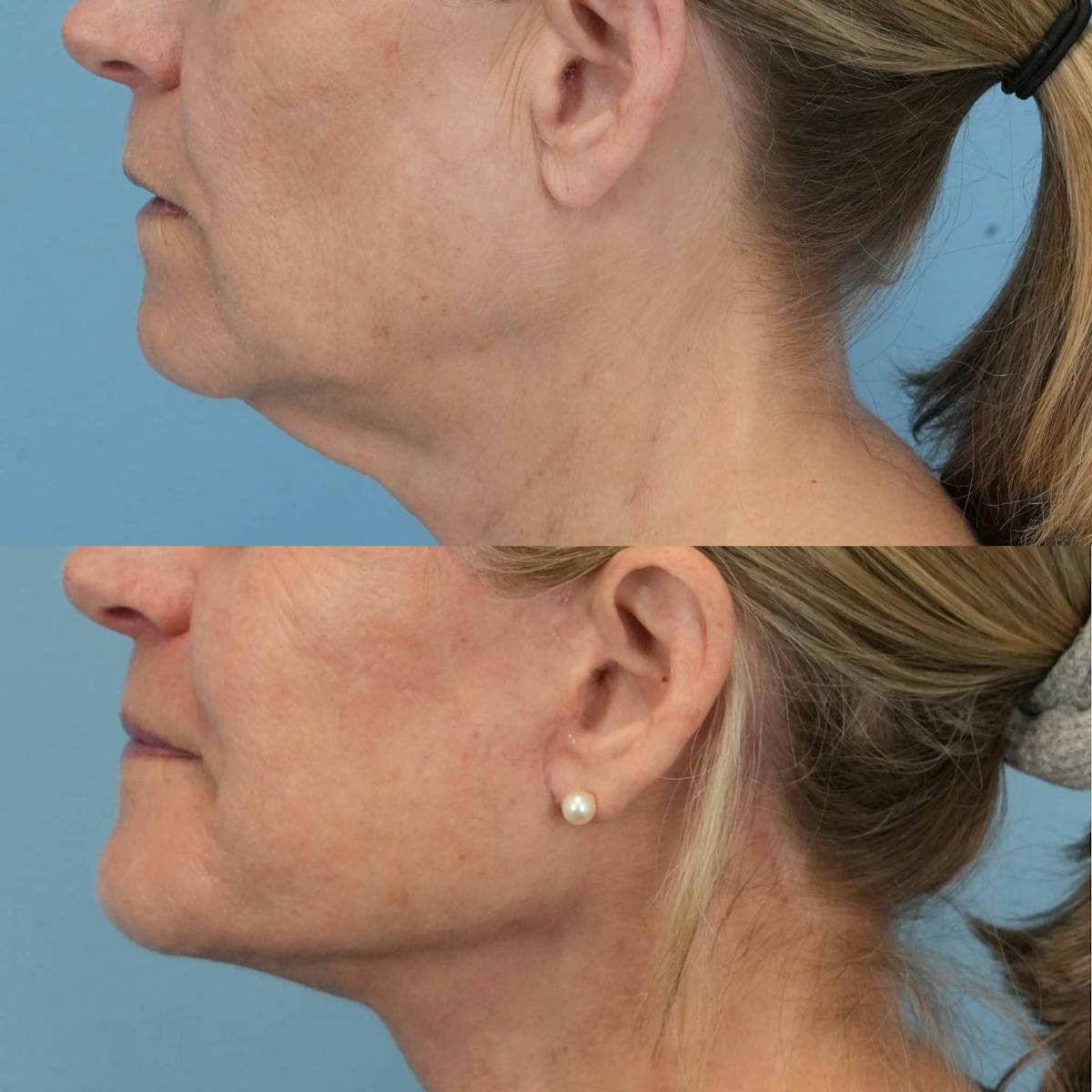 Facelift Before & After Gallery - Patient 577373 - Image 3