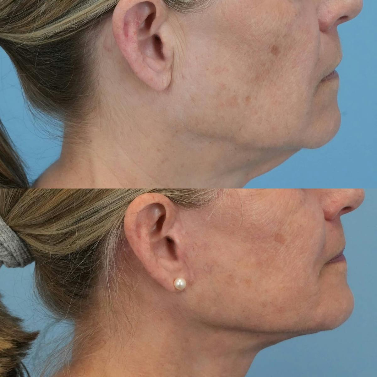 Facelift Before & After Gallery - Patient 577373 - Image 4