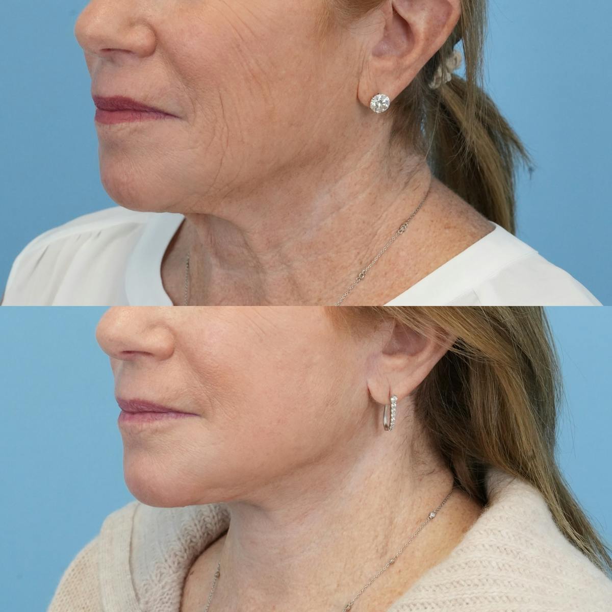 Facelift Before & After Gallery - Patient 167250 - Image 4