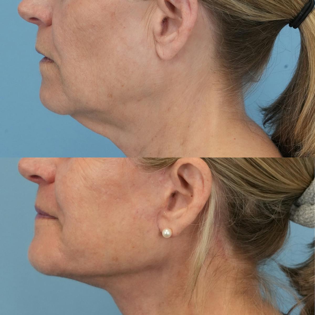 Facelift Before & After Gallery - Patient 794143 - Image 5