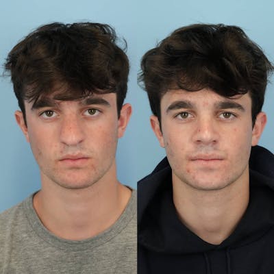 Rhinoplasty Before & After Gallery - Patient 253009 - Image 1