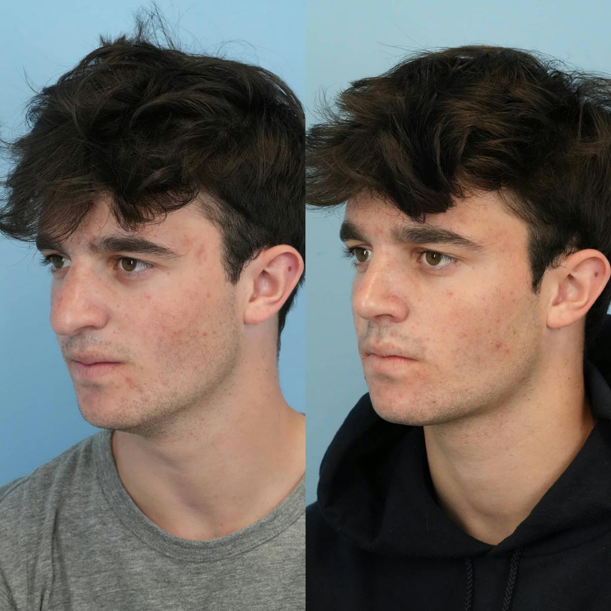 Rhinoplasty Before & After Gallery - Patient 253009 - Image 4