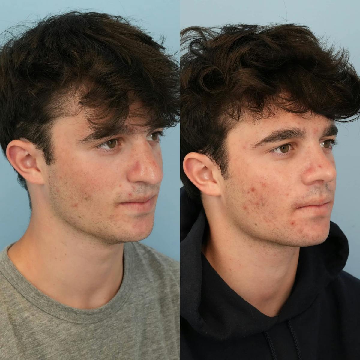 Rhinoplasty Before & After Gallery - Patient 253009 - Image 5